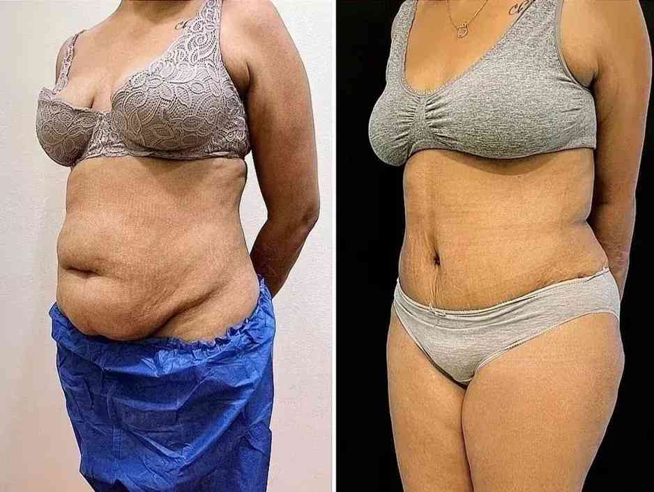 تائج شفط الدهون في إيران قبل وبعد