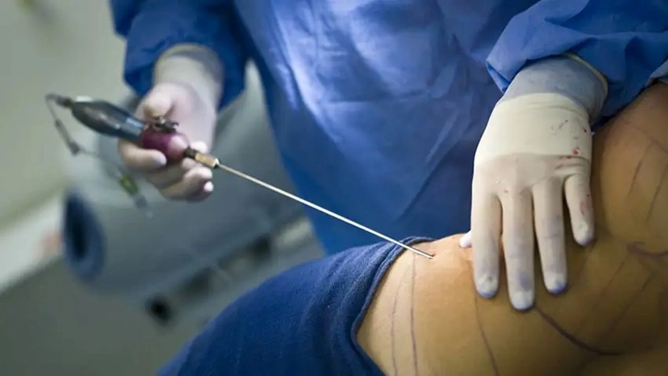 جراح تجميل يجري عملية شفط الدهون في إيران