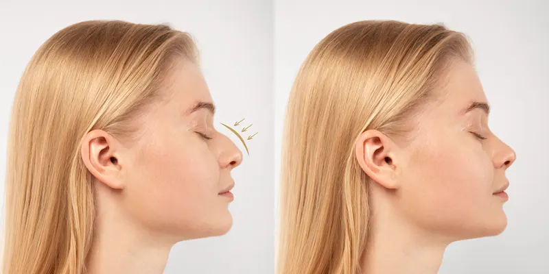 تجميل الأنف في إيران