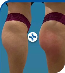 شد المؤخرة البرازيلية في إيران