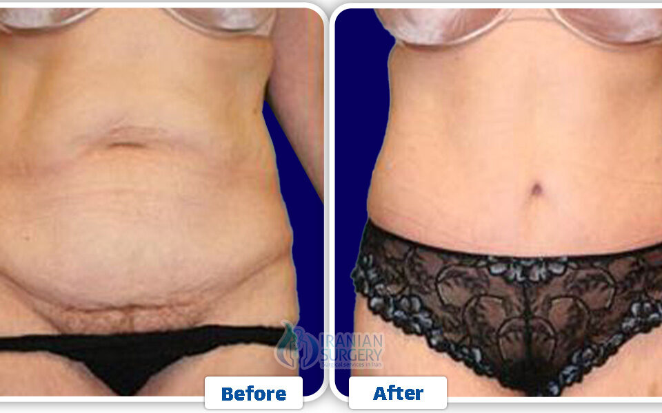 التجميل بعد الولادة في إيران