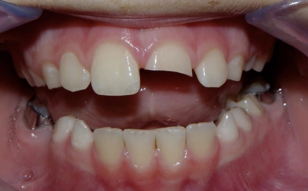 ما هو كسر الأسنان؟