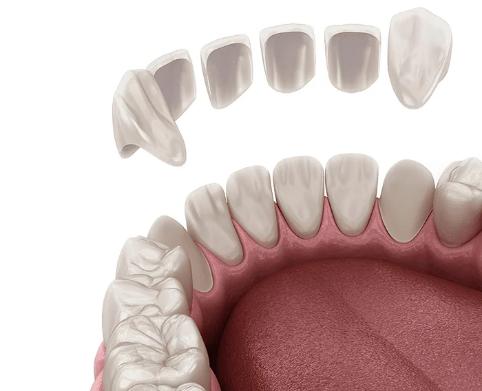 قشور الأسنان