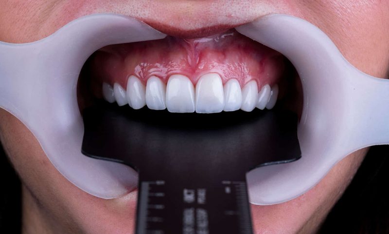 تصوير الأسنان الاحترافي