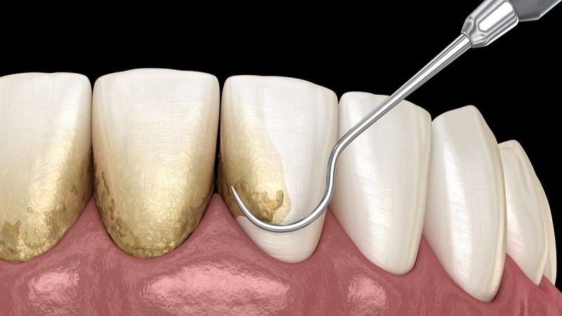 تقشر الأسنان