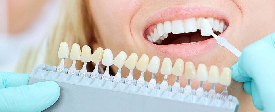 كيف تصفيح الأسنان؟