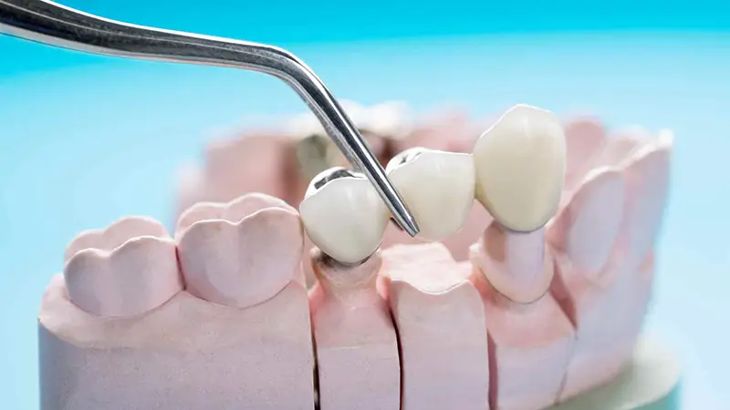 صناعة التركيبات السنية (الثابتة والمتحركة)