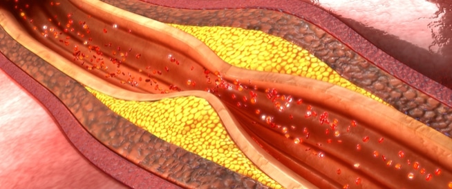 متلازمة الشريان التاجي الحادة