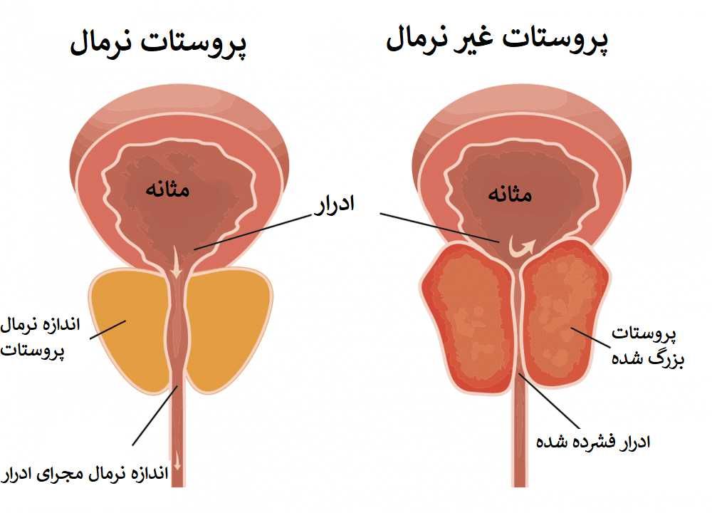 تضخم البروستاتا الحميد