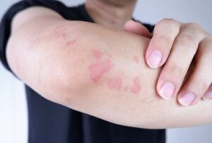 علاج الأمراض الجلدیة الشائعة 