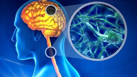 احدث الطرق لعلاج التصلب المتعدد (MS) في إیران