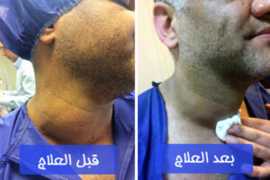 علاج مشاكل الغدة الدرقية في إيران