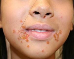 علاج الأمراض المعدية النادرة في إيران