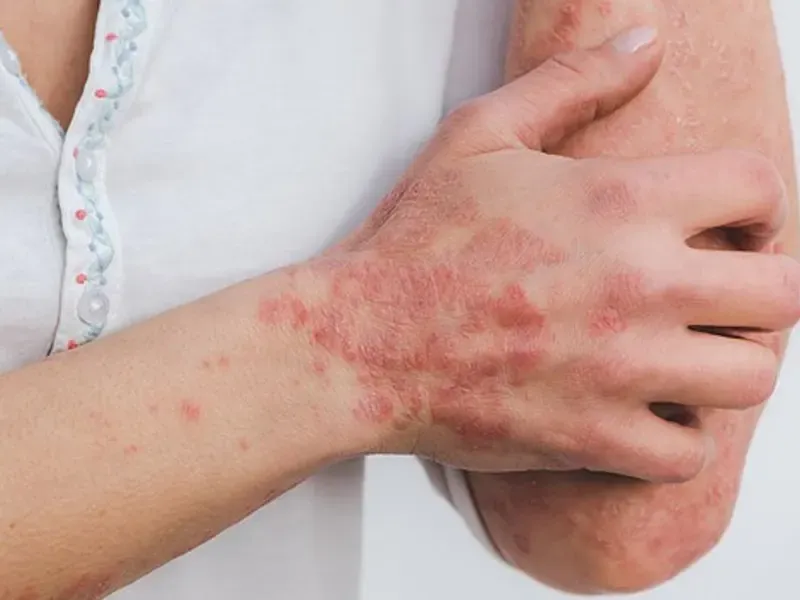 تقدم إيران في علاج أمراض المناعة الذاتية