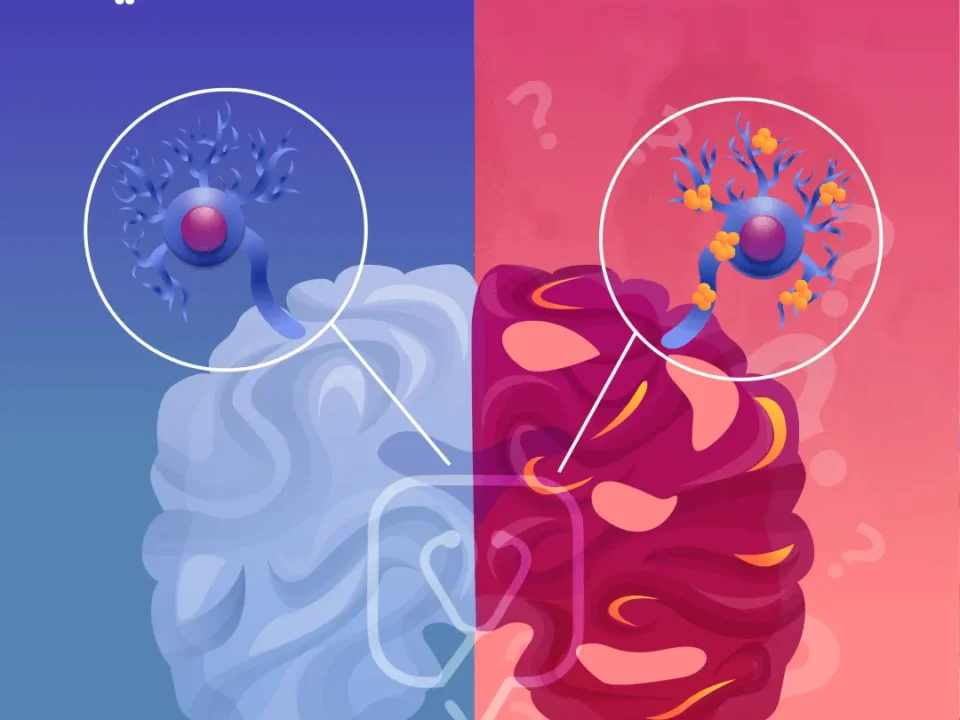 تقنيات علاج الزهايمر الحديثة في إيران