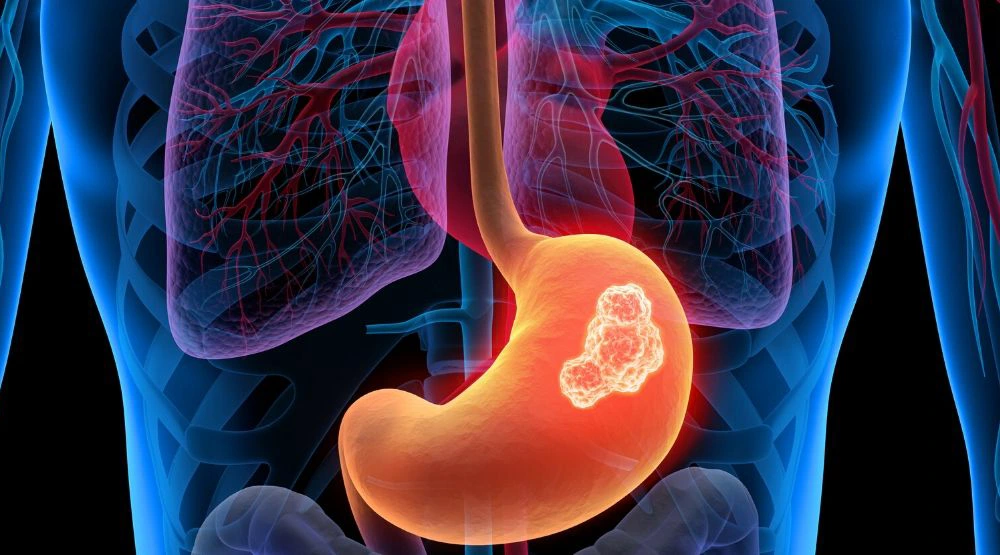 علاج سرطان المعدة