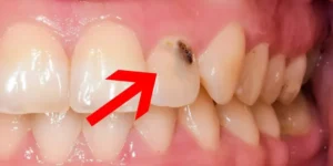 تسوس الأسنان: الأسباب، الأعراض، والعلاج