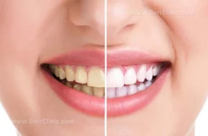 تتبييض الأسنان بطريقةٍ علميّة