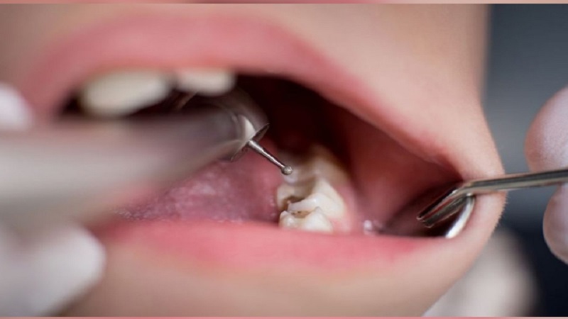 أنواع جراحة الأسنان